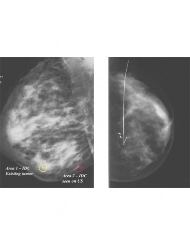 Breast tissue markers, Radiology Reference Article