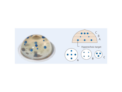 Set of two breast phantoms 2 transparent phantoms for training in biopsy under echography