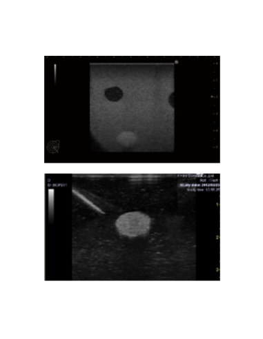 Set of two breast phantoms 2 transparent phantoms for training in biopsy under echography Set of two breast phantoms 2 transparent phantoms for training in biopsy under echography