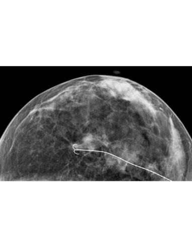 Breast Localization D wire - 19.5G x 9 cm (box of 10) Breast Localization D wire - 19.5G x 9 cm (box of 10)
