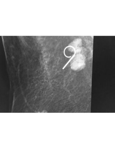 Repositionable breast Localization wire 20G x 5cm / box of 10 Retractable hook unic flexibility Repositionable breast Localization wire 20G x 5cm / box of 10 Retractable hook unic flexibility